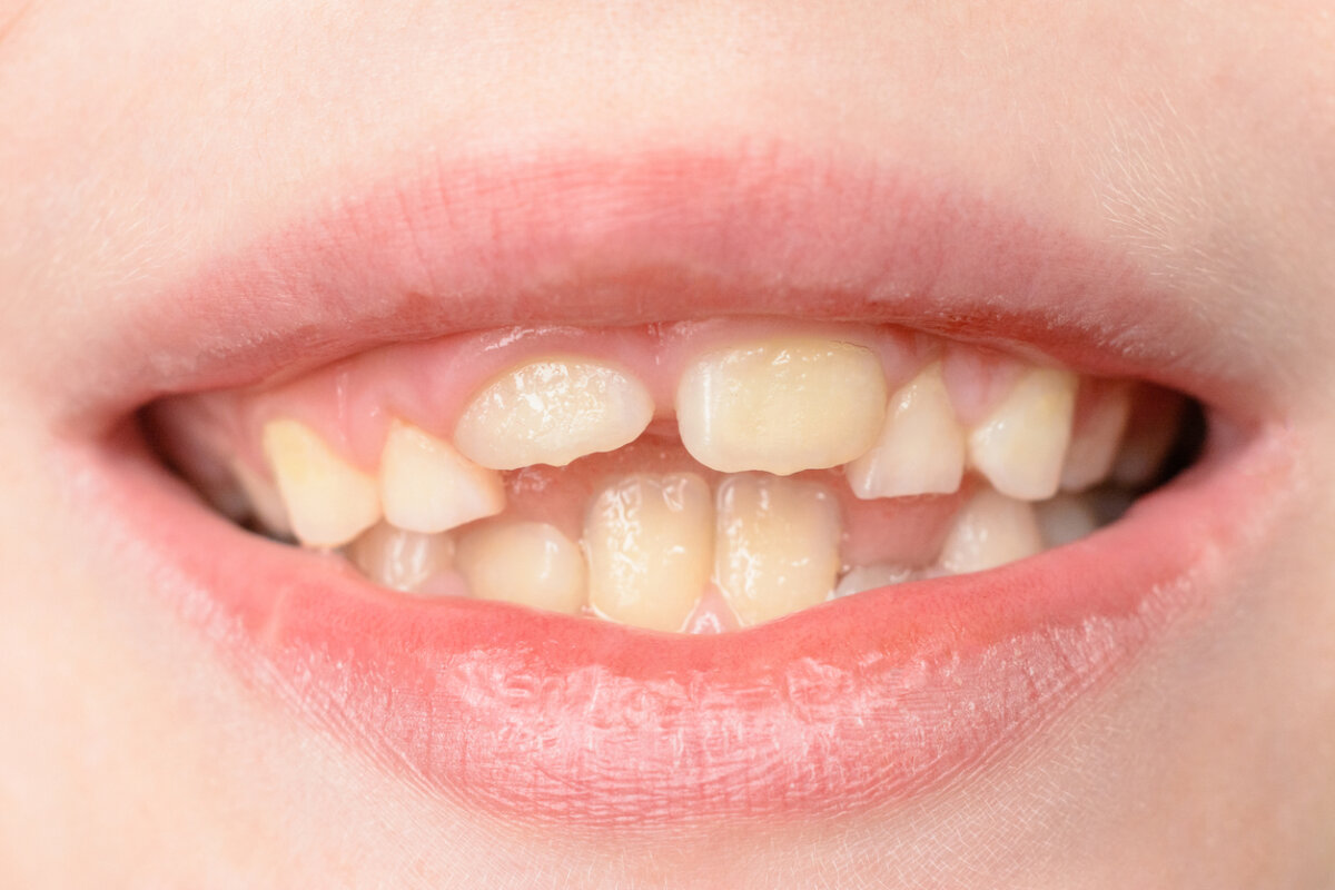 ¿Los dientes de leche torcidos son un problema?