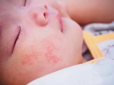 10 tipos de alergia de piel más comunes en bebés