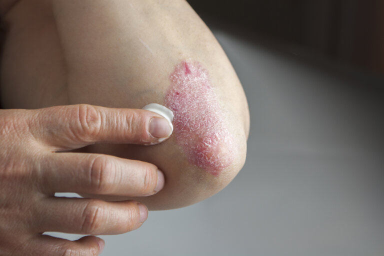 Psoriasis.