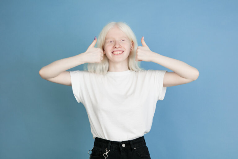 Une jeune fille atteinte d'albinisme.