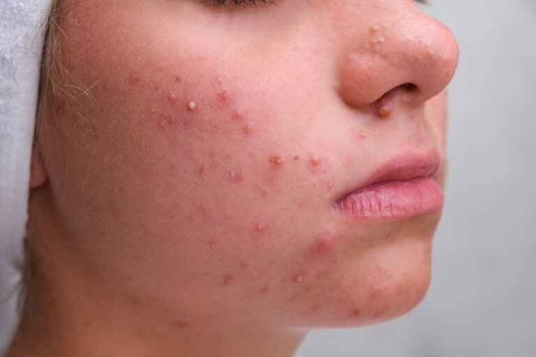 20 datos clave para entender el acné en adolescentes