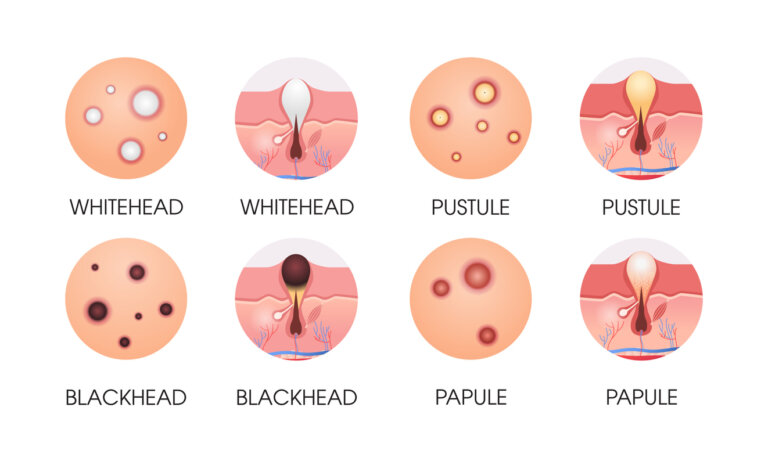 Développement de l'acné.