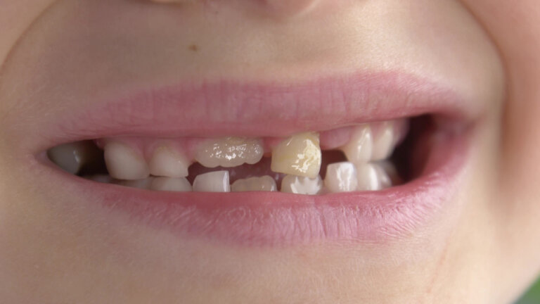 ¿Se pueden corregir los dientes torcidos en los niños?