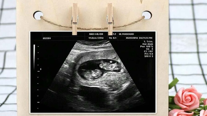 En lugar de olvidar las ecografías de tu hijo en una carpeta, mejor úsalas como parte de tu decoración.
